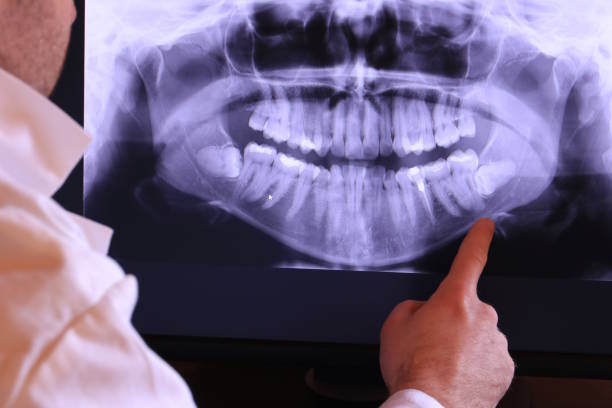 Best Knocked-Out Tooth (Avulsed Tooth) Treatment in Elizabethton, TN