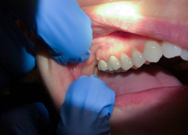 Best Emergency Treatment for Oral Infections in Elizabethton, TN